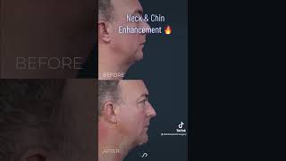 Neck Liposuction and Chin implant  BEFORE and AFTER [upl. by Lamson]