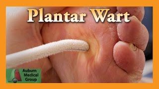 Plantar Wart Treatment  Auburn Medical Group [upl. by Yahsat500]