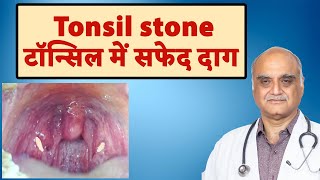 Tonsil stone । टॉन्सिल में पथरी । टॉन्सिल में सफेद सफेद जमा होना । Hindi [upl. by Carce]