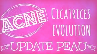 ACNE  Cicatrices évolution update de ma peau se débarrasser des cicatrices dacné [upl. by Cindie]