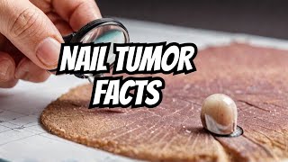 Glomus Tumor in Nail Bed Everything You Need to Know [upl. by Shurlocke482]