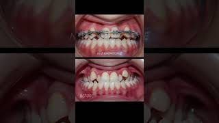 Underbite Braces  Niềng răng cắn ngược [upl. by Rech]