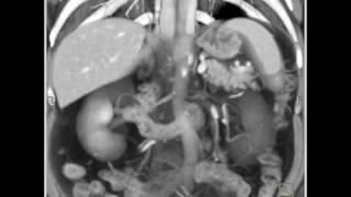 Duplication of IVC [upl. by Leboff]