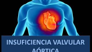 Insuficiencia de la válvula aórtica  Fisiopatología [upl. by Losiram921]