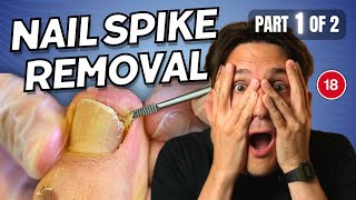 Ingrown Toenail Spike Removal part 1 of 2 [upl. by Ajtak]