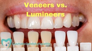 Veneers vs Lumineers [upl. by Malley586]