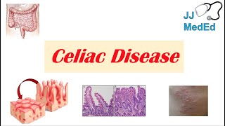 Celiac Disease amp Gluten Sensitivity Risk Factors Pathogenesis Symptoms Diagnosis Treatment [upl. by Moishe]