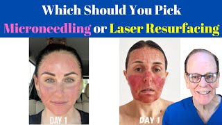 Should You Get Microneedling or Laser Resurfacing  Plastic Surgeons Advice [upl. by Blight]