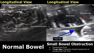 Abdominal Ultrasound Normal Vs Abnormal Images  Liver Gallbladder Pancreas Kidney Hernia USG [upl. by Ardnaeed]