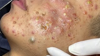 Big Cystic Acne Blackheads Extraction Blackheads amp Milia Whiteheads Removal Pimple Popping  1458 [upl. by Coraline]