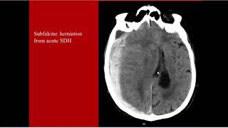 Full Story Brain Herniation CT MRI Ahmed Esawy [upl. by Sivar]