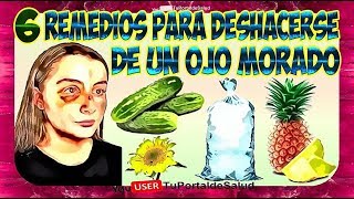 6 Remedios Para Deshacerse de un Ojo Morado Como Quitar un Moretón Ojo Morado [upl. by Orfield737]