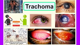 trachoma [upl. by Tilda]