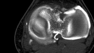 Kyste méniscal et Arthroscanner [upl. by Rednav]