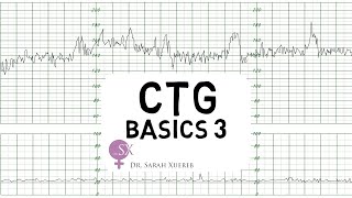 CTG Basics Part 3  Overall Assessment amp Examples [upl. by Suiluj11]