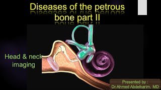 6pathology of the petrous bone II [upl. by Gweneth142]