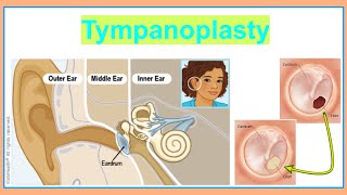 tympanoplasty [upl. by Hakim177]