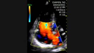 VSCAN Atrial Septal Defect Pocket ultrasound Comunicación interauricular [upl. by Ettennaej]