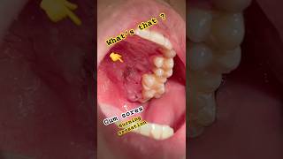 Mouth disease Gum and palatal Sores [upl. by Yve]