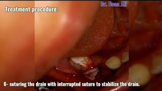 What is the role of drain in treatment of odontogenic infection [upl. by Asilram]