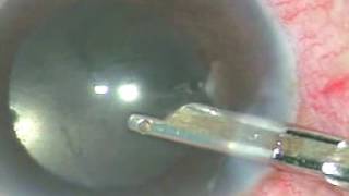 Anterior Chamber lavage for removal of Hypopyon amp inflammatory membrane covering IOL  P Mohanta [upl. by Okim924]