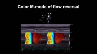 Echocardiography Essentials Detecting aortic regurgitation [upl. by Gridley]