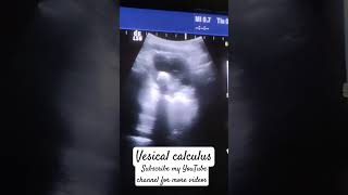 Vesical calculus on ultrasoundUrinary bladder pathology pelvic ultrasound [upl. by Ayk]