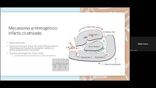 Arritmias ventriculares en CPI [upl. by Ariuqahs]