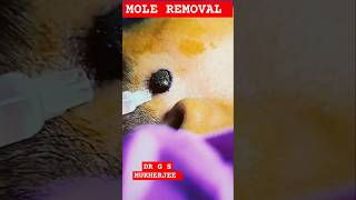 Mole removal shorts viral moleremoval drgsmukherjee moleremove trending dermatologist [upl. by Eicul780]