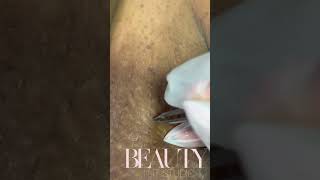 Ingrown Hair Removals [upl. by Nahgeam11]