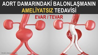 EVARTEVAR  Aort Anevrizmasının Ameliyatsız Tamiri [upl. by Adnuhsed975]