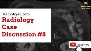 Choledochocele and Choledochal Cyst  Imaging approach Case based Radiology Board Review Case [upl. by Mcdonald]