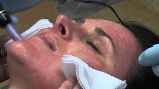 Dr Mark B Taylor Review of Dermapen Micro Needling  Gateway Aesthetics [upl. by Arden]