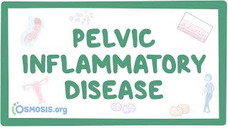 Pelvic inflammatory disease  causes symptoms diagnosis treatment pathology [upl. by Pyszka872]