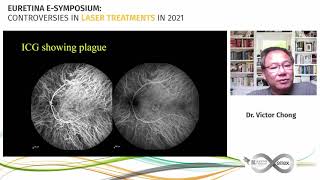 EURETINA 2021  CONTROVERSIES IN LASER TREATMENTS IN 2021 [upl. by Maroj]