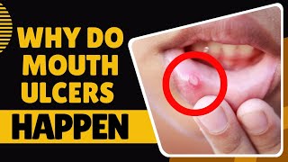 What Causes Mouth Ulcers [upl. by Kal]