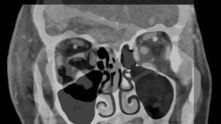 Periorbital Cellulitis [upl. by Ekaj567]