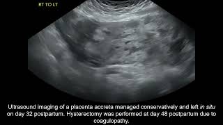 Placenta accreta spectrum conservative management and coagulopathy [upl. by Gussie42]