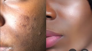 How To Cover Acne Scars feat Best Concealer For Dark Spots  Everyday Makeup Routine Fairrah♡ [upl. by Broome]