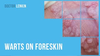 😕 Warts on foreskin [upl. by Kleiman418]