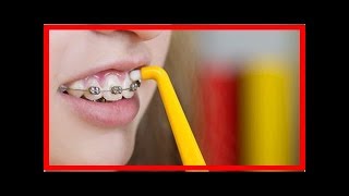 Aprende a blanquear los dientes con brackets [upl. by Sollie]