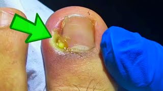 The WORST Infected Toenail Removal Youve Ever Seen [upl. by Darrelle]