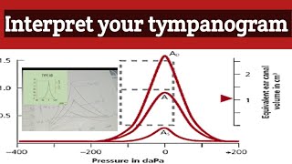 Tympanometry test  Tympanogram interpretation  how to read tympanogram selflessmedicose [upl. by Geiger]