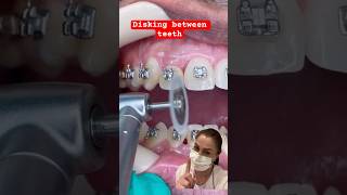 BRACES and DISKING Orthodontics [upl. by Liv]