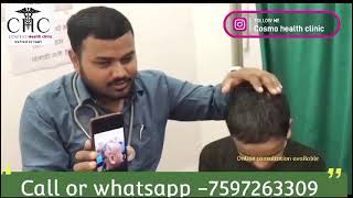 alopecia treatment [upl. by Careaga]