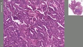 Endometrial Adenocarcinoma  Histopathology [upl. by Ellinehc]