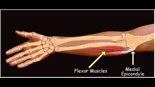 Epicondilite Medial Cotovelo ELETROESTIMULAÇÃO NEUROMUSCULAR FLEXORES Fisioterapia Dr Robson Sitta [upl. by Dyan]