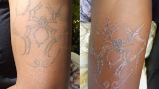 Laser Tattoo removal 4th session PICOSECOND laser [upl. by Gan]