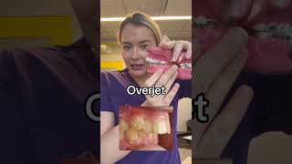 Overjet vs overbite braces overbite overjet [upl. by Htennek]