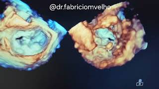 Necrose caseosa no anel mitral Componente móvel em face Ventricular [upl. by Ainsworth]